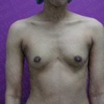 Breast Augmentation Before & After Patient #1844