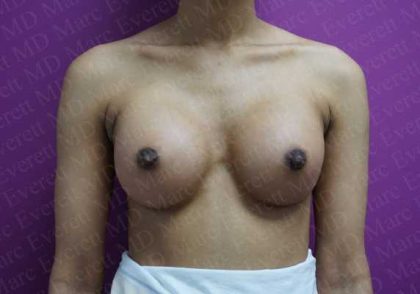 Breast Augmentation Before & After Patient #1844