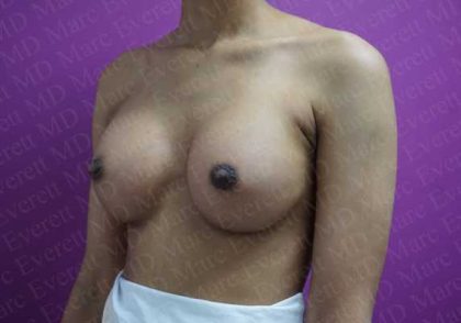 Breast Augmentation Before & After Patient #1844