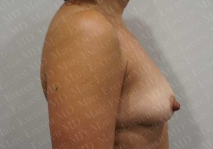 Breast Augmentation Before & After Patient #1841