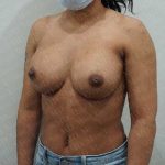 Breast Augmentation Before & After Patient #1840