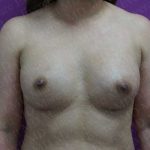 Breast Augmentation Before & After Patient #1812
