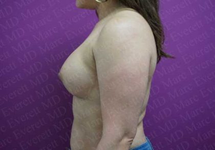 Breast Augmentation Before & After Patient #1812