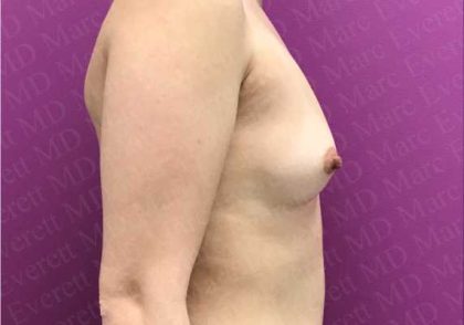 Breast Augmentation Before & After Patient #1810