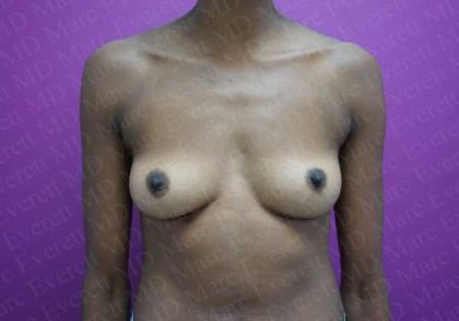 Breast Augmentation Before & After Patient #1790