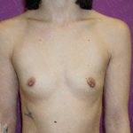 Breast Augmentation Before & After Patient #1788