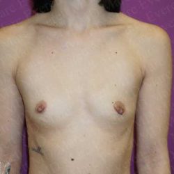 Breast Augmentation Before & After Patient #1788