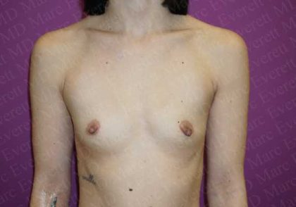 Breast Augmentation Before & After Patient #1788