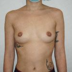 Breast Augmentation Before & After Patient #1922