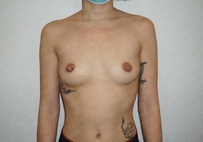 Breast Augmentation Before & After Patient #1922