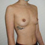 Breast Augmentation Before & After Patient #1922