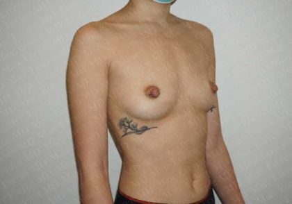 Breast Augmentation Before & After Patient #1922