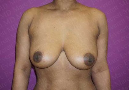 Breast Augmentation Before & After Patient #1772