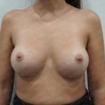 Breast Augmentation Before & After Patient #1771