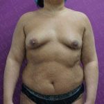 Breast Augmentation Before & After Patient #1770