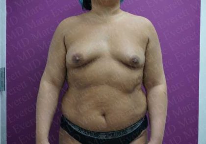 Breast Augmentation Before & After Patient #1770