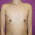 Breast Augmentation Before & After Patient #1664