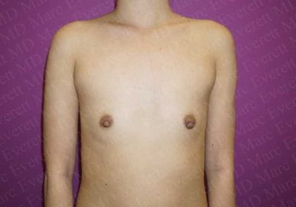 Breast Augmentation Before & After Patient #1664