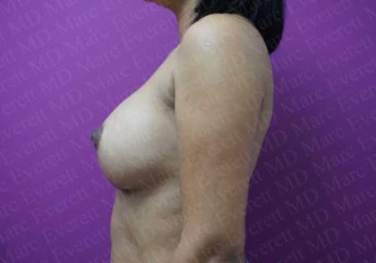 Breast Augmentation Before & After Patient #1920