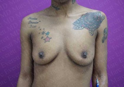 Breast Augmentation Before & After Patient #1918