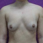 Breast Augmentation Before & After Patient #1898