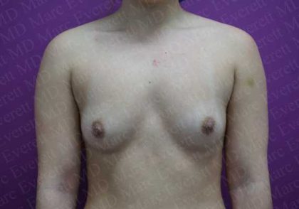 Breast Augmentation Before & After Patient #1898