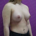 Breast Augmentation Before & After Patient #1898