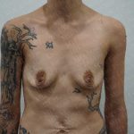 Breast Augmentation Before & After Patient #1896