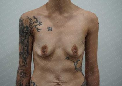 Breast Augmentation Before & After Patient #1896