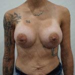 Breast Augmentation Before & After Patient #1896