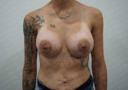 Breast Augmentation Before & After Patient #1896