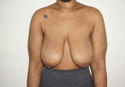 Breast Lift Before & After Patient #1997