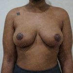 Breast Lift Before & After Patient #1997