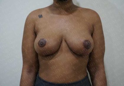 Breast Lift Before & After Patient #1997