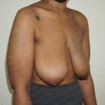 Breast Lift Before & After Patient #1997