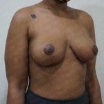 Breast Lift Before & After Patient #1997