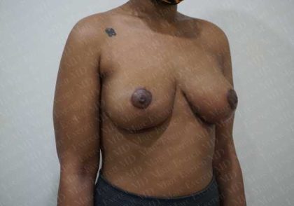 Breast Lift Before & After Patient #1997