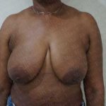 Breast Lift Before & After Patient #1980