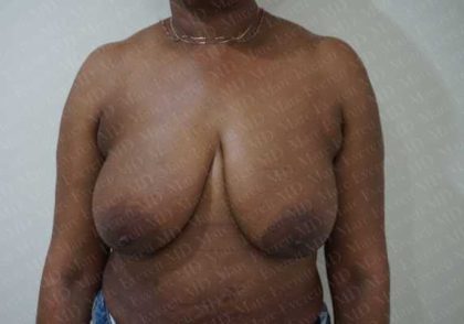 Breast Lift Before & After Patient #1980