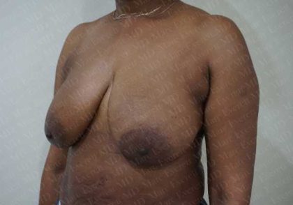 Breast Lift Before & After Patient #1980