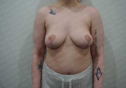 Breast Lift Before & After Patient #1978