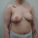 Breast Lift Before & After Patient #1978