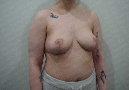 Breast Lift Before & After Patient #1978