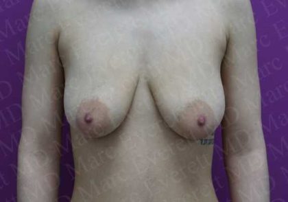 Breast Lift Before & After Patient #1969