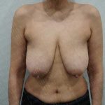 Breast Lift Before & After Patient #1965