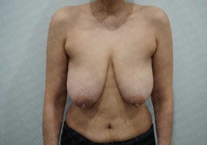 Breast Lift Before & After Patient #1965