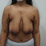 Breast Lift Before & After Patient #1995