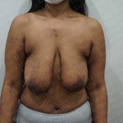 Breast Lift Before & After Patient #1995