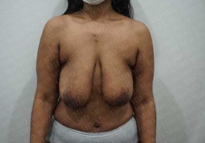 Breast Lift Before & After Patient #1995