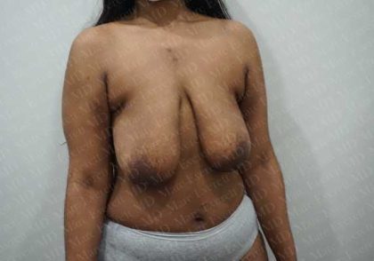 Breast Lift Before & After Patient #1995